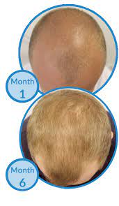 Hence, using it along with your shampoo can never disappoint you. Can Garlic Shampoo Cure Male Hair Loss