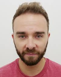 As Jack P. Shepherd shows off his thicker thatch, these men reveal their  hair transplant hell