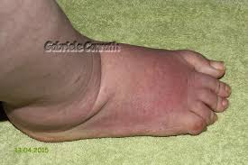 Er tut nur beim auftreten weh und an einer stelle ist druckschmerz. Gabriele S Conga Crafts Blog Fuss Umgeknickt 12 Update Stoffe