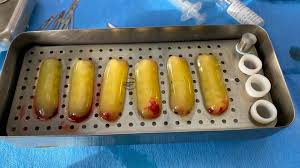 High platelet fibrin is an automatrix released from the blood. Bone Grafting Prf