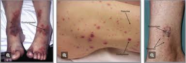 It is a singular medical condition that gives rise to small red spots over the skin when petechia rashes appear first, they are red in color. Petechiae Purpura And Vasculitis Flashcards Quizlet
