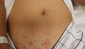 How to remove bacteria from hot tub. Hot Tub Folliculitis Skin Physicians Surgeons