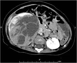 Image result for Nephroblastoma