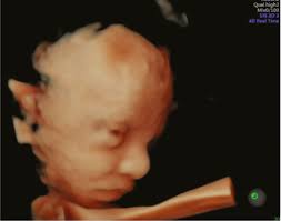 Diagnosis Of Fetal Syndromes By Three And Four Dimensional Ultrasound Is There Any Improvement