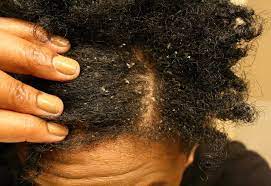 Mild dandruff can be caused by many things, including dry skin. Get Rid Of Dandruff On Natural African Hair 4c Hair Black African Hair