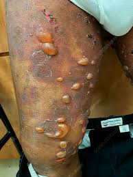 Image result for Pemphigoid