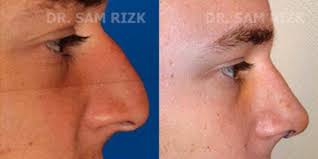 Nose Job Operation Image By Dr Sam Rizk, MD, New York, New York (10028) »  Rhinoplasty: Cost, Pics, Reviews, Q&A