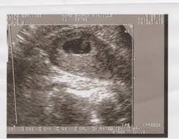 4d ultrasound pregnancy 7 weeks twins full screen. Twins At 7 Weeks Ultrasound