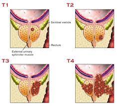 If breast cancer is diagnosed at an early enough stage, it's treatable. Staging Prostate Cancer Measuring Its Severity Prostate Matters