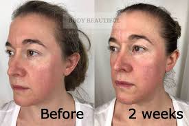 The tria precision laser works to ensure permanent hair removal. Tria Age Defying Laser Before Vs After Review 3 Month Trial Photos
