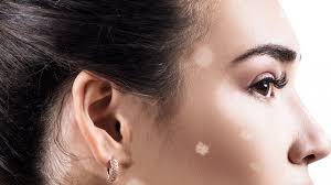 And they appear on the face (cheeks' area), upper trunk, arms, shoulders, mouth, and chin areas. White Spots On Face Causes Medical Treatment And Home Remedies Top 10 Home Remedies