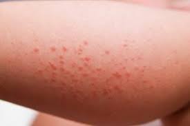 Image result for allergy rash on the legs