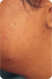 Additionally, cost is affected by the size and number of treatment regions. Small Tattoo Removal Cost Uk Novocom Top