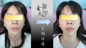 邱澤夏醫師- [(針醫美學)美顏拉提案例分享] 今天不寫內容，讓⋯⋯ 🔎大家來找碴，請你們來說說有什麼不一樣？...