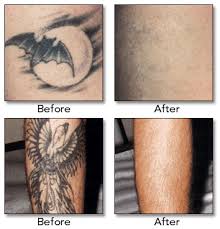 Refresh and rediscover the natural beauty of your hair with a customized hair treatment. Tattoo Removal Jackson Ms
