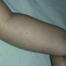 Puntos Rojos En El Brazo Alguien Sabe Que Puede Ser Bebes De Abril 2015 Babycenter