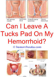 How long do hemorrhoids usually last. How Long Hemorrhoids Last Bleeding Hemorrhoids Hemorrhoids Treatment Internal Hemorrhoids
