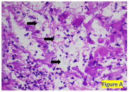 Image result for Cryptococcal Meningitis