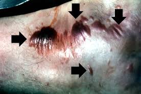 Common properties of clostridium perfringens Gas Gangrene Case Study One Wikidoc