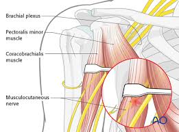 The shoulder isn't just one bone, it's actually made up of three different bones and various tendons, ligaments, and muscles.the three bones located in the shoulder are the humerus, the scapula, and the clavicle. Deltopectoral Approach To The Proximal Humerus