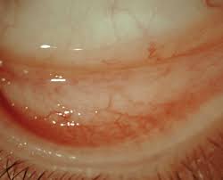 Image result for Allergic Conjunctivitis