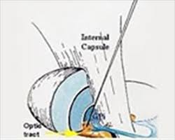 Image result for Pallidotomy