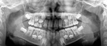 Case report and a review emphasizing local recurrence. Aneurysmal Bone Cyst Ddmfr Oral And Maxillofacial Radiology