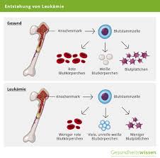 Leukamie Ursachen Symptome Behandlung Von Blutkrebs