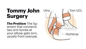 Tommy john surgery is performed to reconstruct elbow ligaments, usually a result of a common sports injury from overusing the throwing arm. Why Tommy John Is Against The Surgery Named For Him