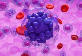 Image result for Lymphoma