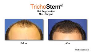 In fact, the american academy of dermatology reports that, by age 40, as much as 40% of all women have experienced visible hair loss. Main Causes Hair Loss In Men And How To Treat Trichostem