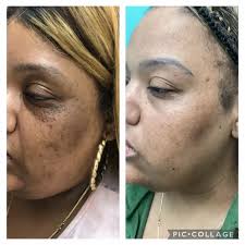 Struggling with dark spots, melasma , or uneven skin tone? Ask us about our  treatments that can help!✨, ., ., ., ☎️702-257-6398, #newunaturalbeauty  #medspa #lasvegas #glowup #selfcare #botox ...