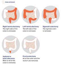 Bowel cancer may also be called colon cancer or rectal cancer, depending on where the cancer is located and begins. Treatment For Early Bowel Cancer Cancer Council Victoria