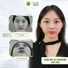 GIẢI MÃ SÓNG MŨI 3D: CÔNG NGHỆ TẠO DÁNG MŨI THÔNG MINH THEO TỪNG MILIMET