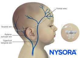 Image result for Difficult Intravenous Access in Children