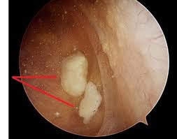 However, in the meantime, you can unlock your knee by reducing the swelling . Locked Knee Treatment Knee Pain Explained
