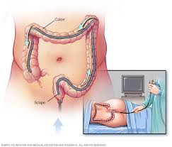 Image result for Microscopic Colitis