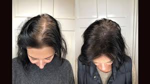 The exact percentage of how many women have breast hair isn't known, since this isn't something that has been studied at large or that women usually report to their doctors. Scalp Micropigmentation Benefits Side Effects Before After Pics