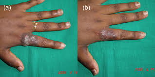 Tuberculosis verrucosa cutis (43%) was the commonest type of skin tb than lupus vulgaris (30%), erythema induratum of bazin (13.3%) and others cutaneous types (13.3%). Clinico Histopathological Correlation And The Treatment Response Of 20 Patients With Cutaneous Tuberculosis