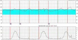 Image result for Non-Stress Test