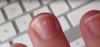 What Do Those White Marks On Your Nails Mean White Patches On Nails White Lines On Nails White Spots On Nails