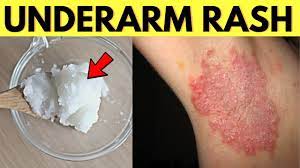 Then go out to buy it and it's not there anymore or can't find it anywhere. Try This Remedy To Heal Underarm Armpit Rash From Natural Deodorant Youtube