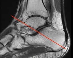 Atypical Scan Angles In Musculoskeletal Mri Radsource