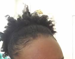 As mentioned earlier, rashes are a pretty common side effect of using hair dyes and you will mostly observe them on the areas where the dye has been used and any other area where the skin has come in contact with the hair product. Highlightdarkhair Vaida Hair Dye Side Effects