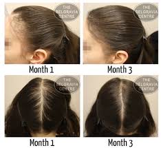 Like we discussed earlier, hormone levels can severely affect hair loss and growth, so any compound that messes with your natural levels may result in unwanted hair loss. Does Katy Perry Have Thinning Hair