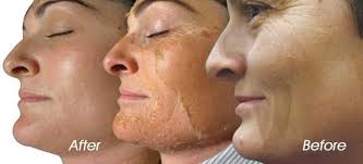 While transdermal application is the most popular use of microneedles, intraocular and intracochlear microneedle drug delivery systems are emerging. Chemical Peel Dover Oh Canton Oh Ohio Laser Wellness Centers