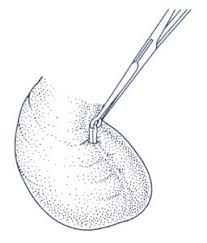 We surveyed providers in new york city and several other u.s. No Scalpel Vasectomy Procedure In Calgary With Dr Crouse