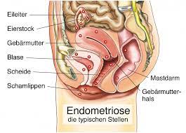 Selbst frauen, die ihren mittelschmerz regelmäßig spüren, haben symptomfreie monate. Eisprung Schmerzen Hilfe Und Ursachen Heilpraxis