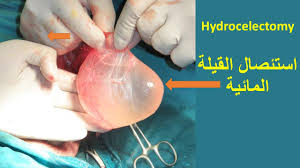 Hydrocelectomy استئصال القيلة المائية Youtube