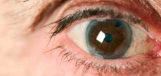 Las cataratas pueden evolucionar a un ritmo distinto en cada ojo, lo que puede dar lugar a síntomas visuales en un ojo y una visión normal en el otro. Que Son Las Cataratas En Los Ojos Clinica Internacional